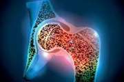 Low Bone Mineral Density and Associated Factors Among People Living With HIV in Kerman Iran A Cross Sectional Study in 2021 2022